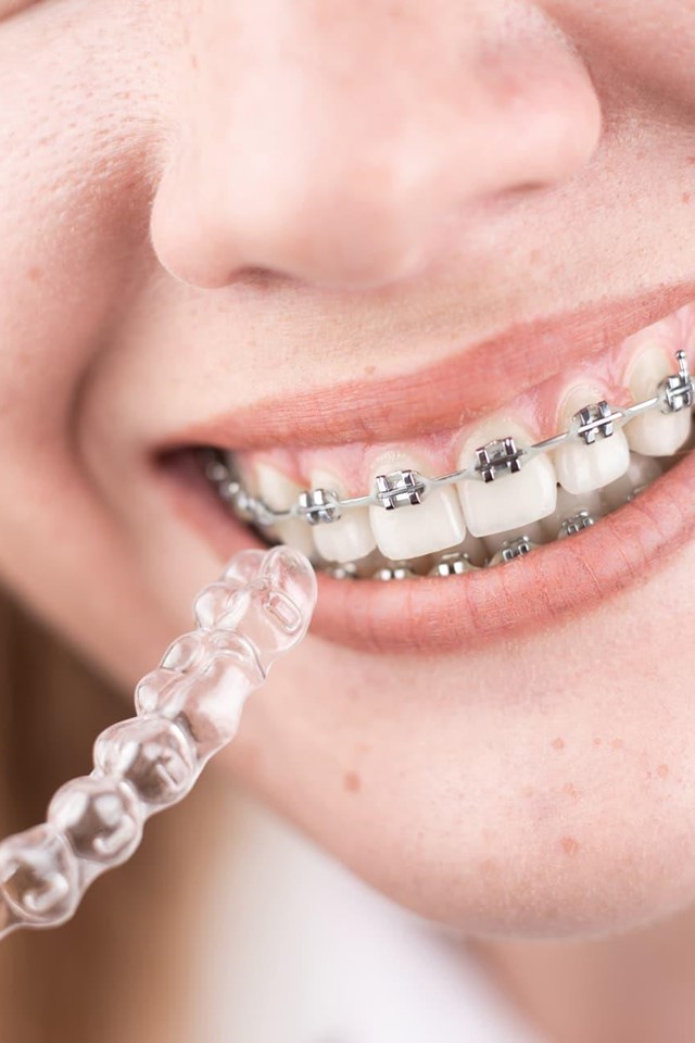 ¡20% de descuento en ortodoncia invisible (Invisalign)!