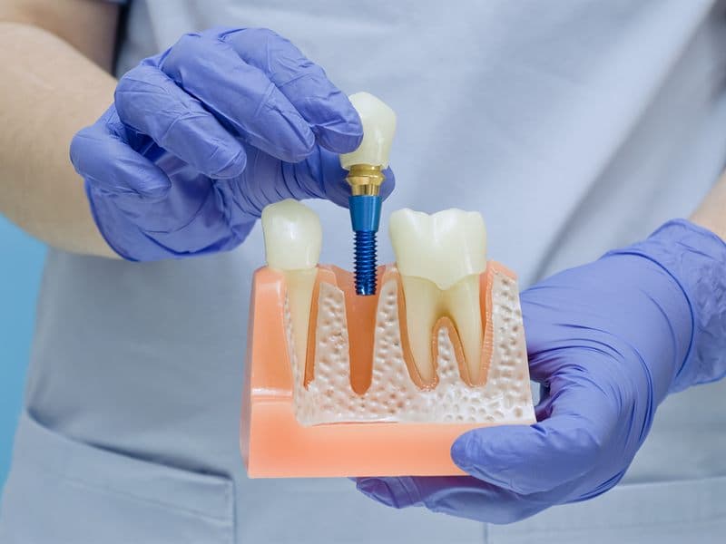 Implantes dentales de carga inmediata en Ribeira